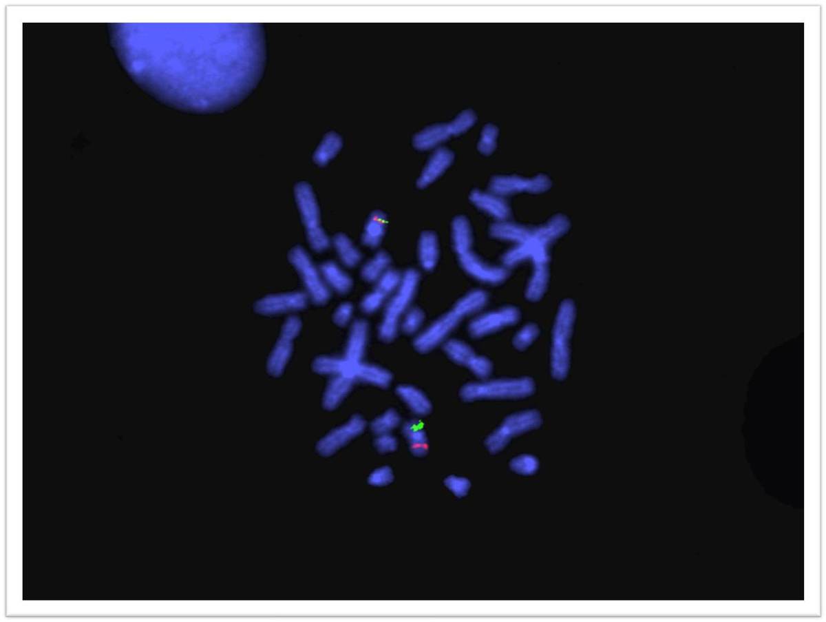 Fluorescence in situ hybridization demonstrating 1 red signal (CBFB probe), 1 green signal (MYH11 probe) and one fusion signal
